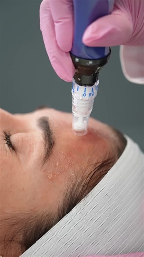 Transform Your Skin with SkinPen and Rejuran