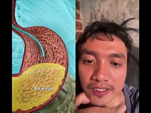 How a nasal feeding tube works 😨