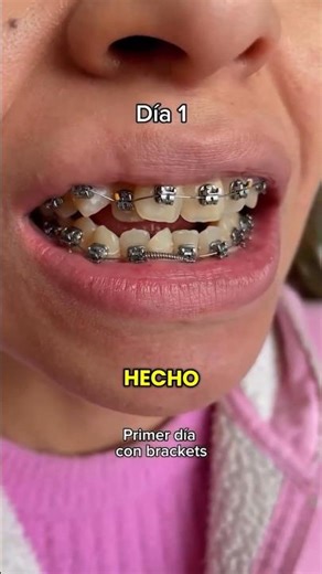 Si piensas que sólo debes llevar brackets si tienes los dientes torcidos, te equivocas