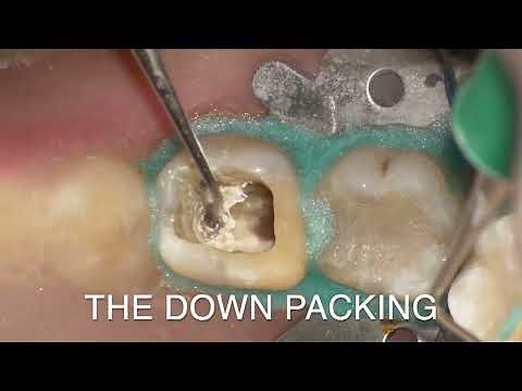 Warm vertical condensation technique-the most efficient technique in obturation of root canal system