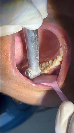Access opening for RCT #dentistry