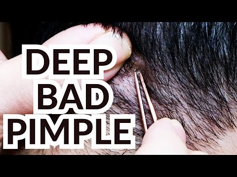 DEEP OLD HAIRY PIMPLE #AcneTreatment #BlackheadRemoval #PimplePopping #IngrownHairRemoval