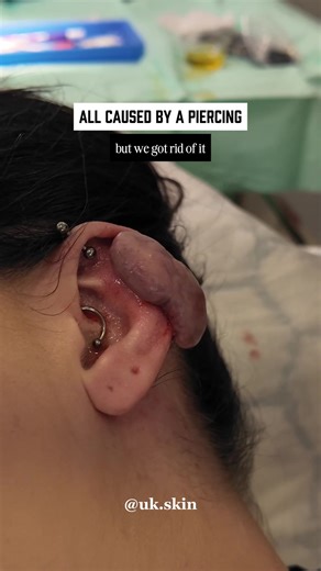 POV: You got a piercing and now you've got a keloid 😩 Here's what's happening: Your body makes collagen to heal wounds, but sometimes it doesn't stop - creating that raised, bulky scar that keeps growing. Keloids can come from piercings, cuts, burns, acne, literally any skin trauma. More common if you have darker skin or they run in your family. And yeah, they're itchy, painful, and annoying. We treat them two ways = Steroid injections for smaller ones / Surgical removal steroids for bigger one