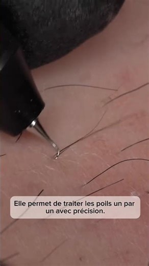 ✨ Électrolyse by My Laser : la précision absolue Dans cette vidéo, vous voyez comment l’électrolyse