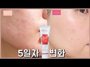 레이저크림 피부 속상할때 재생크림 추천 셀퓨전씨 5일 사용후기
