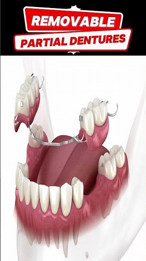 Can you eat normally with partial dentures?”