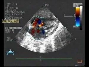 Atrial Septal Aneurysm With Multiple Atrial Shunts And Ventricular Septal Defect • Video • MEDtube.net