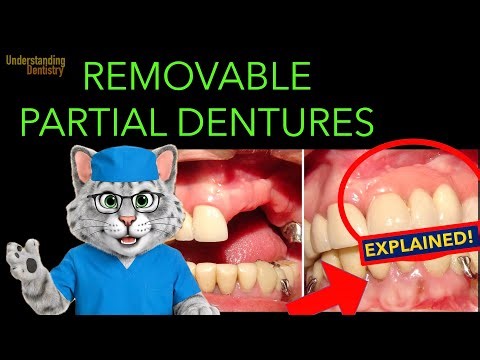 RPD EASY: ALL Parts, Classification and Components of Removable Partial Dentures!!