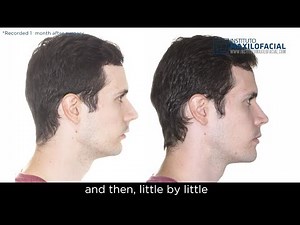 Jaw surgery Case # 88: Javier - Class II, facial asymmetry, overbite