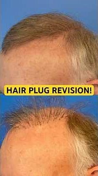 Incredible Hair Transplant Correction Procedure!
