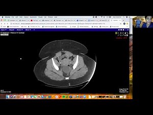 Retrorectal cystic lesion DDX! - Dr. Aarti Sekhar