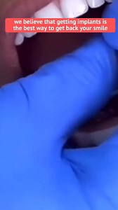 𝗗𝗢 𝗡𝗢𝗧 𝗣𝗔𝗬 $2,000 Per Implant: Full mouth or single tooth procedures (pricing on the next page) 👇👇 | Body Hacks