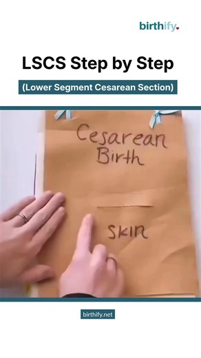 Birthify on Instagram: "From Incision to Baby — LSCS in Action 👶✂️ Ever wondered exactly what happens during a Lower Segment Cesarean Section (LSCS)? 🤔 This super helpful breakdown walks you through the core surgical steps, layer by layer! You get to see the process—from the initial skin incision all the way through fat, fascia, muscles, peritoneum, uterus, and finally, the amniotic sac—right up to the safe delivery of the baby. 🤯 Understanding the anatomy and the steps can be incredibly empo