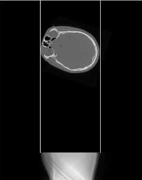 Radon Transform: Head