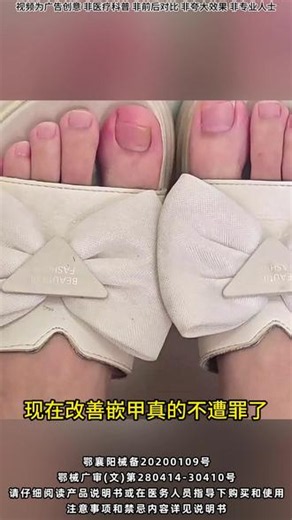 告诉你一个改善嵌甲的好方法，不用再忍受嵌甲烦恼啦 #嵌甲泡脚有用吗 #甲沟肿了怎么办 #大脚趾盖往肉里长怎么办 #脚趾炎是什么引起的 #正甲贴