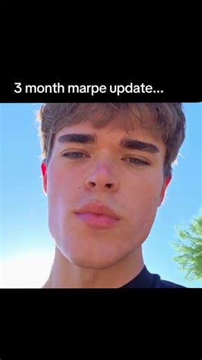 health indicators are destroyed rn. time to fix that. accutane will fix my skin and bulbous nose. the sebaceous glands have returned to their original size are inflamed. #bwython #lm #marpe #airwayorthodontics #bones