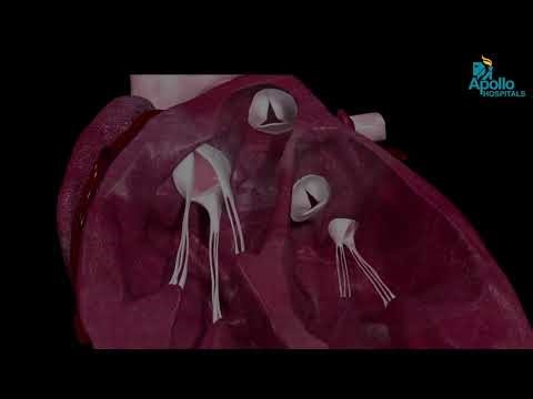 What Is Heart Valve Repair? | Doctor Explains Simply