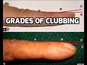 Quick Internal medicine: Grades of CLUBBING of finger nails
