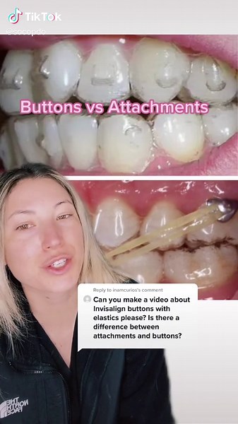 Differences Between Invisalign Attachments and Buttons Explained