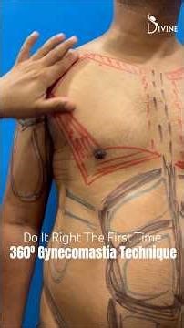 How the 360° Technique Fixes Gynecomastia the Right Way? About Gynecomastia Surgery