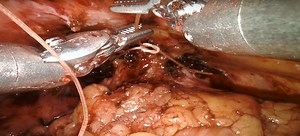 Robotic cystectomy: Ileal conduit | Urology Times