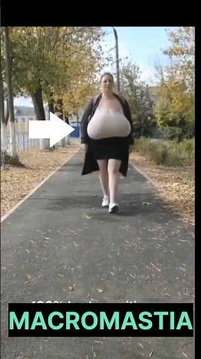 MACROMASTIA # MBBS # SHORTS