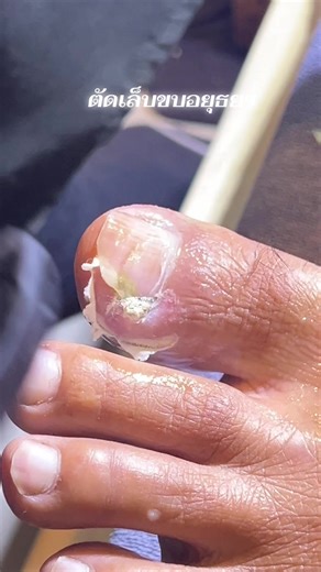 EP1062 งานแก้ ดูแลครบจบปัญหา #ตัดเล็บขบอยุธยา #ตัดเล็บขบใกล้ฉัน #ตัดเล็บขบ