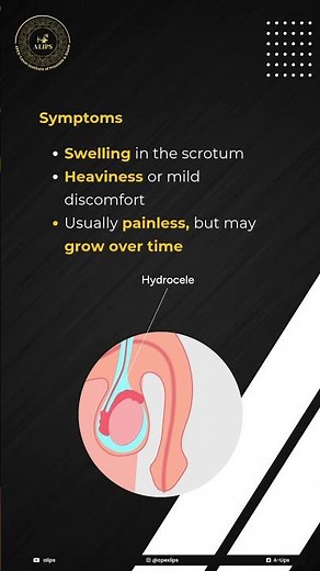 Hydrocele Explained: Causes, Symptoms & What You Need to Know