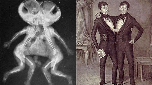 Medical miracles and strong connections: the record-breaking history of conjoined twins