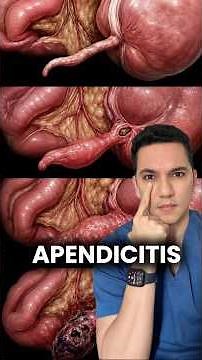 The dangerous progression from an inflamed appendix to peritonitis. #healthtips #medicine