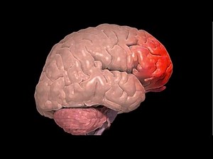 What is a Cerebral Contusion?