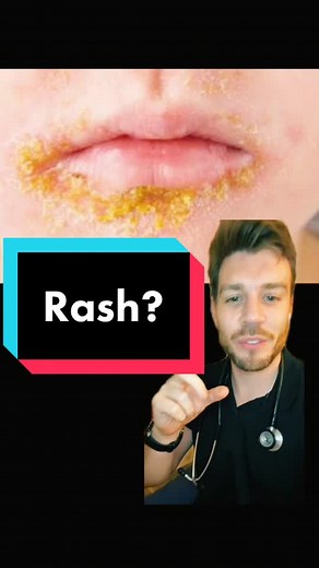 Dealing with Impetigo: Causes, Symptoms, and Treatment