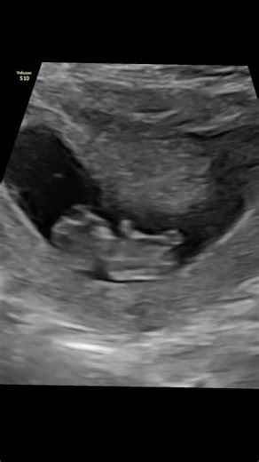 Grateful for a Healthy 10-Week Baby Scan