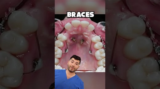 Braces explained