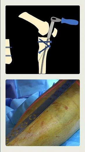 Suprapatellar Tibial Nailing – Key Steps and Locking Sequence