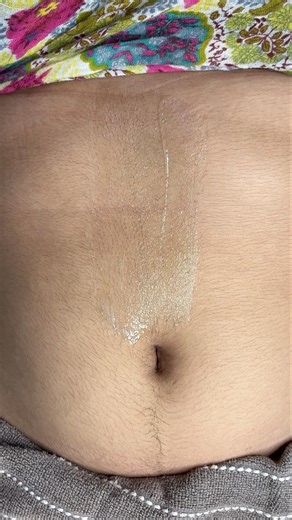 Tummy hair waxing bride to be/ Pre Bridal Waxing tutorial/ #tummywaxing #gelwax #beauty #skincare