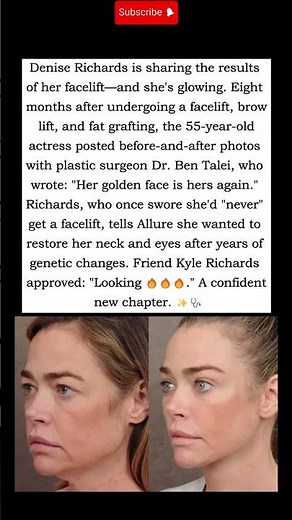 Denise Richards Reveals Dramatic Facelift Results Her Golden Face Is Hers Again #shorts #facelift