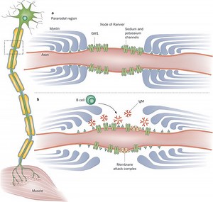 Neuropatía motora multifocal: causas, síntomas y tratamiento - Cerebro - Del Sistema Nervioso 2025