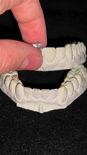 10on10 permanent hybrid 6 pointer VVS lab diamond grillz. Ready for installation Let the quality speak for itself.Get your grillz and jewelry done right with Agoradiant online or at our shop in Houston, Texas✅monthly payment available.#htx #texas #grillz #diamondgrillz #hiphop #hiphopculture #hiphopjewelry #customgrillz #rap | Agoradiant