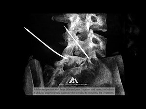 3D CT-Guided Navigation for Pars Fracture Spondylolisthesis Patching Bridging Repair Procedures