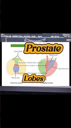 Prostate Ultrasound | Enlarged Prostate | BPH | Median Lobe Prostate | Prostatomegaly on Usg