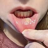 Dentemp Canker Cover Mouth Sore Treatment - Oral Pain Relief for Canker Sores & Mouth Irritation - Fast-Acting Pain Relief Tablets for Adults - Value Pack of 1 (8 Count)