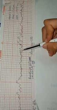 cardiotocograph part 2