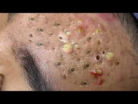 Crazy Pimple Extraction Compilation 2026 😱