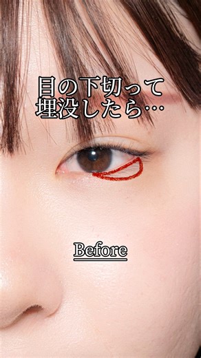 【二重整形】タレ目形成#shorts