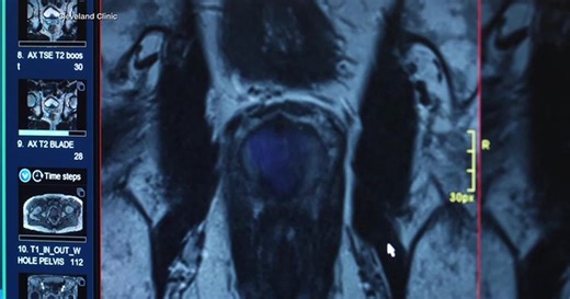 New AI tool for prostate cancer