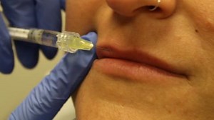 See These Belotero Injections to the Upper Lip