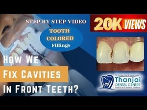 How to fix cavities between front teeth?| Composite filling video| How dentist remove tooth decay?