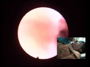 DISE( DRUG INDUCED SLEEP ENDOSCOPY)