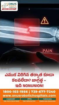 ఫ్రాక్చర్ అయిన తర్వాత కూడా ఎముక కలవలేదా_ ఇది Nonunion కావచ్చు!